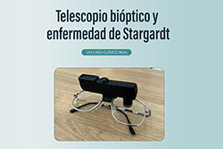 Telescopio Bi�ptico y enfermedad de Stargardt
